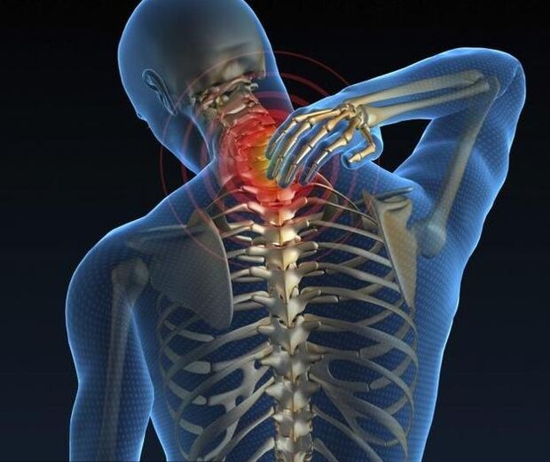 Cervikalna osteohondroza