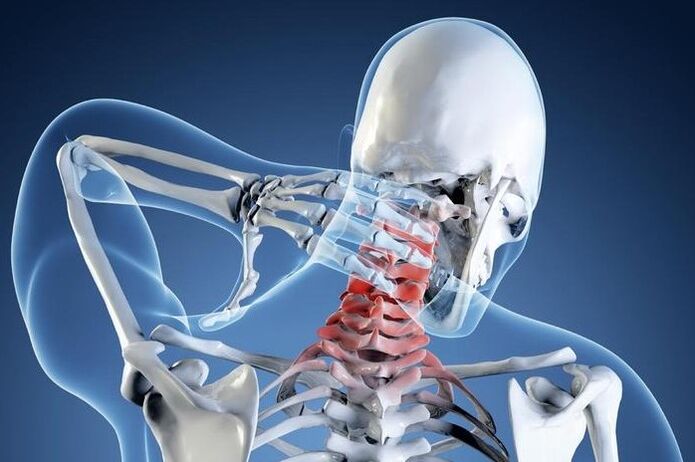 Osteohondroza 1. stepena