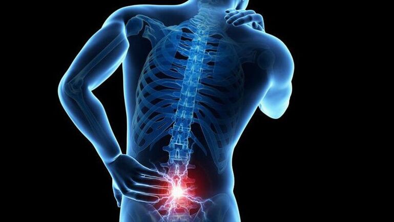 Simptomi lumbarske osteohondroze